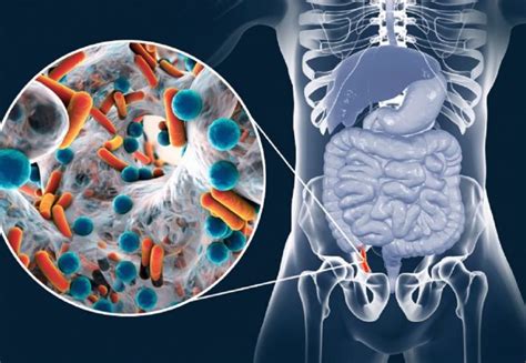 apendicita acuta|Apendicita Acuta: Cauze, Simptome, Diagnostic și。